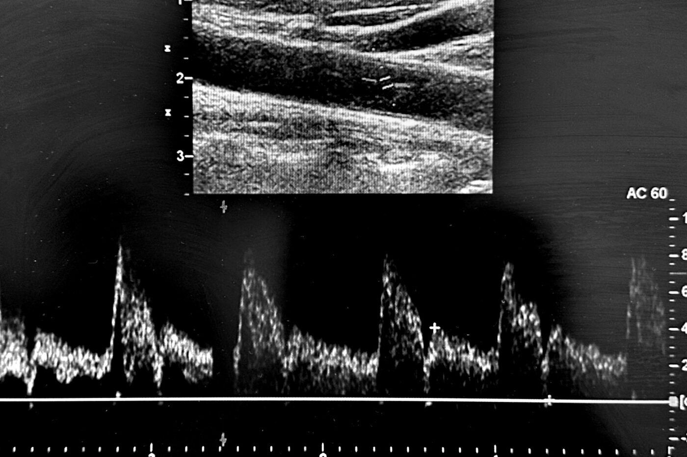 Doppler-Sonographie der Halsgefäße